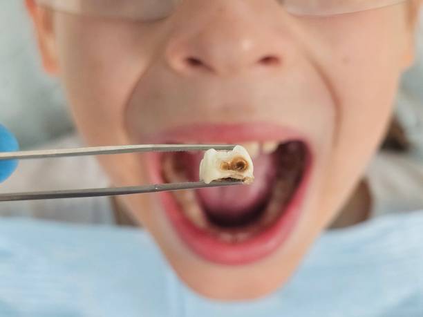 Best Emergency Wisdom Teeth Removal in Baxter Estates, NY